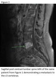 Image result for Chondrosarcoma