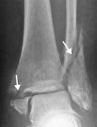 Image result for Ankle XRay