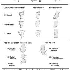Approximately 50% of cases of clubfoot affect both feet. A Summary Of The Clubfoot Assessment Protocol Cap Download Table