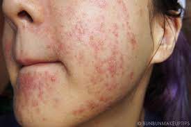 We did not find results for: Wajah Gadis Cantik Ini Rusak Setelah Facial Beauty Fimela Com