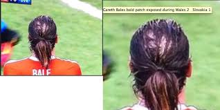 Che poi secondo me il vertex di bale a capelli sciolti non mostra diradamenti, se ha lasciato crescere i . Gareth Bale Con La Chierica Pagina 2