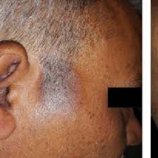Symptoms of hair dye allergy : Allergic Contact Dermatitis To Hair Dyes With Lichenoid Plaques A Download Scientific Diagram