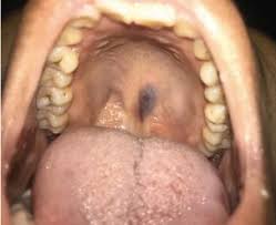 Rev latin infect pediatr 2020; Medigraphic Oficial ×'×˜×•×•×™×˜×¨ Mucormicosis Rinoorbitaria En Ninos Con Inmunosupresion Serie De Tres Casos Y Revision De La Literatura Https T Co Gvnusseo2k Mucormicosis Inmunosupresion Anfotericina B Https T Co Wfxt14jqkx