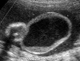 Image result for Labial Fusion