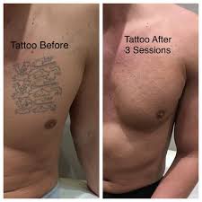 The price can range from £50 for a single session to remove a small tattoo, to more than £1,000 for several sessions to remove a large tattoo. How Much Is Tattoo Removal Laser Deera Chat Blog