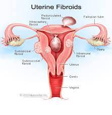Treatment for uterine fibroids depends on your symptoms. Uterine Fibroids Causes Treatment Symptoms Diet Surgery