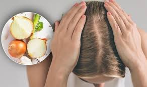 Female pattern hair loss and androgen excess: Hair Loss Treatment The Simple Onion Juice Home Remedy To Boost Hair Growth Sound Health And Lasting Wealth