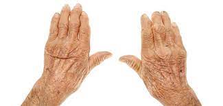 Rheumatologie und allgemeinmedizin • fdr 03|2013 • 29.09.2013 die herausforderung liegt darin, aus der großen gruppe der patienten mit chronischen rückenschmerzen jene mit axialer spondyloarthritis (spa) zu erkennen. Patienten Mussen Zu Lange Auf Erstkontakt Warten