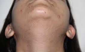 This can involve a single or multiple areas, such as moustache and beard area,. Laser Hair Removal Timeline Hairmd Pune
