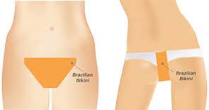 Our painless superior laser hair removal technology is designed for treating face, neck, chest, back, shoulders, bikini, arms, armpits, and legs. Laser Hair Removal Permanent Removal Cost Hair Removal Bikini Treatments Glendale Ca