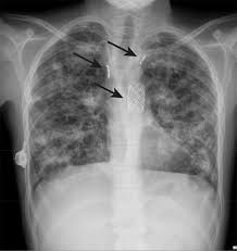 Cystic fibrosis is often thought of as a 'lung disease' owing to a collection of respiratory symptoms that manifest in people with the condition. Recurrent Haemoptysis In A Child With Advanced Cystic Fibrosis Lung Disease The Bmj