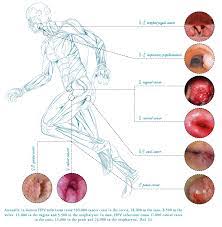 There's no standard screening test to find these cancers early. Spectrum Of Hpv Related Diseases