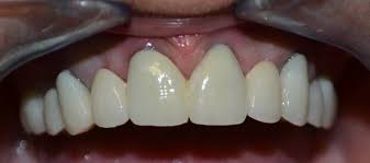 Check spelling or type a new query. Pourquoi Choisir La Couronne Dentaire En Zirconium Smile Partner