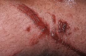 Image result for Rhus Dermatitis