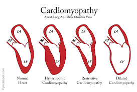 Image result for Cardiomyopathy