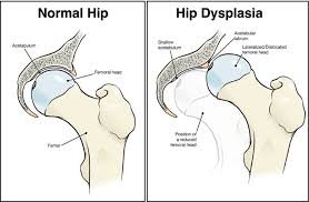 Image result for Hip Labral Tear
