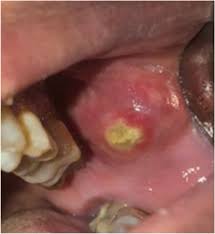 Image result for Sialolithiasis