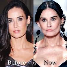 Breaking News: Users Say Demi Moore, 62, Had 'Fillers Removed' Based