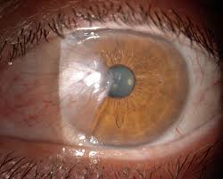 Manchmal sind die augen gerötet und lassen uns sogleich müde oder traurig aussehen. Bindehauterkrankungen Auge Online