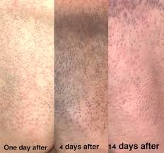 Symptoms are often worse during the first few hours or days after the. Hair Removal Results From One Session Of Laser Hair Removal Skincareaddiction