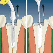 Check spelling or type a new query. Focus On Fiber Post Selection And Placement Criteria A Review Volume 4 Issue 4 Inside Dentistry