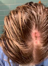 Learn about symptoms, causes, diagnosis, and treatment for cancer in this common location. Melanoma Monday A Reminder To Get That Mole Checked Abc News