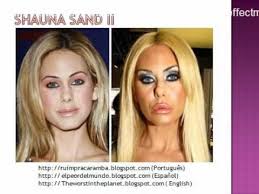 27 Plastic Surgery Fail Before After 27 Cirurgia Plastica Antes Despues Youtube Celebrity Plastic Surgery Plastic Surgery Shauna Sand