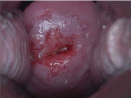 The earliest sign is likely to be an abnormal pap smear detected during a routine gynecologic examination. Cervical Intraepithelial Neoplasia Wikipedia