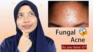 Recent papers in cara menghilangkan jerawat pasir. Everything You Need To Know About Fungal Acne Youtube