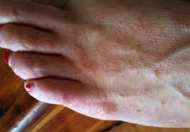 If you have yellow or white bumps that look like pimples on your feet, this may be caused by whiteheads, skin abscess, or cysts. Bumps On Feet Itchy Red Small White Bumps On Bottom Top Of Feet Fluid Filled Spots On Feet