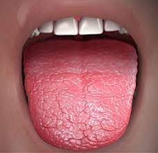 If you've ever overindulged on cocktails on a saturday night, you know that the worst xerostomia is the medical term for dry mouth. Diabetes Dry Mouth Diabetes News