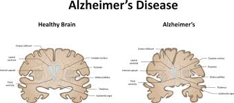 Parkinson disease is recognized as one of the most common neurologic disorders, affecting from vitek j. Diagnosing Neurodegenerative Disease By Tracking Eye Movements