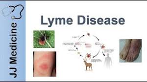 Treatment For Lyme Disease Pennsylvania Lyme Disease Pro
