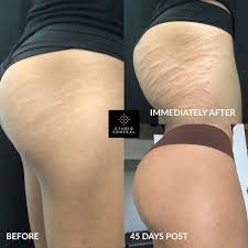 Tattoofilter is a tattoo community, tattoo gallery and international tattoo artist, studio and event directory. Women Of Color Stretch Mark Camouflage Studio Conceal