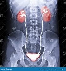 Image result for Intravenous Pyelogram