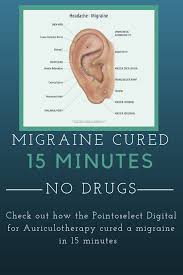 Acupuncture For Migraines Acupuncture Migraine