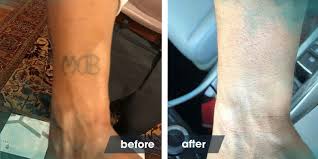 It poses fewer risks of blistering, discoloration, scarring, and an overall painful and. We Give Back To Our Community Removery