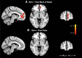 The primary somatosensory cortex is located in a ridge of cortex called the postcentral gyrus, which is found in the parietal lobe. Encoding Of Touch Intensity But Not Pleasantness In Human Primary Somatosensory Cortex Journal Of Neuroscience
