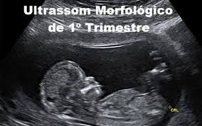 Ultrassom Morfologico De 1º Trimestre Clinisomrad 55 3332 8724 55 3332 7266