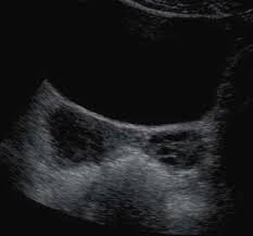 A pelvic ultrasound is a noninvasive diagnostic exam that produces images that are used to assess organs and structures within the female pelvis. Normal Ovary Ultrasound How To