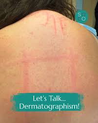 Image result for Dermatographism