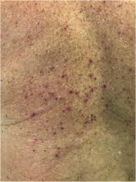 It was first identified in december 2019 in wuhan,. Cutaneous Manifestations Of Covid 19 Report Of Three Cases And A Review Of Literature Journal Of Dermatological Science