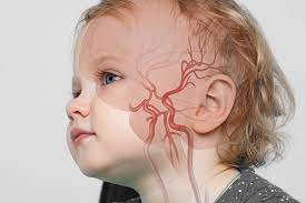 Medicamento Antiinflamatorio Detiene Los Accidentes Cerebrovasculares En Ninos Con Enfermedades Raras Femexer