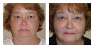 Eyelid Surgery in Jacksonville, FL.
