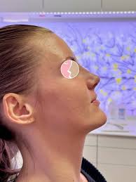 🇬🇧 The same-day result of the nose filler procedure I performed