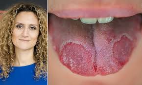 Image result for white cancer on tongue)