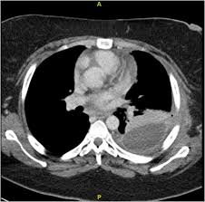 Pleural effusions represent a disturbance between pleural fluid production loculated pleural effusions: Loculated Pleural Effusion Ct File Pleura Effusion Jpg Wikimedia Commons Pleural Effusion Occurs When Too Much Fluid Collects In The Pleural Space The Space Between The Two Layers Of The