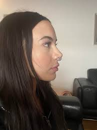 Update- Finally took my cast off today and to say i'm absolutely over the  moon is an understatement!! can't believe this is my new nose😍😍 Before &  After>>