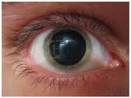 Image result for Mydriasis
