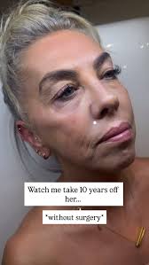 ✨ 10 years younger… without surgery., This gorgeous lady didn’t want to  look different just like herself again. A little lift, a little definition,  a little refresh… and suddenly it’s giving ...